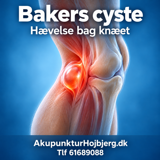Bakers Cyste
